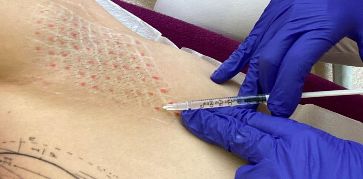 Botox bei axillärer Hyperhidrose: Effektive Hilfe gegen übermäßiges Schwitzen